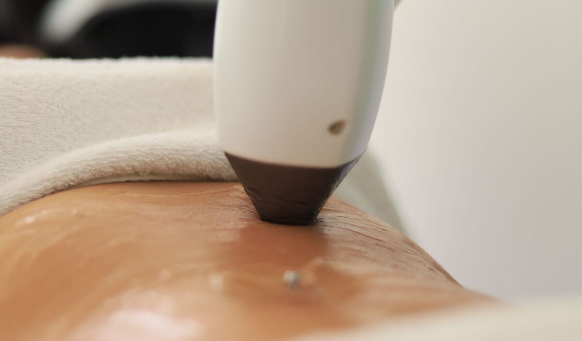Lasertherapie (vaatlaser)